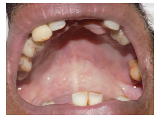 oral submucous fibrosis blanching